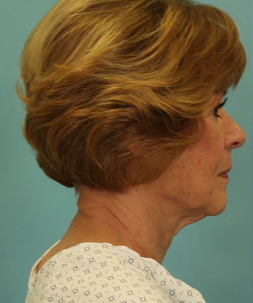 before facelift right side view female patient case 1248