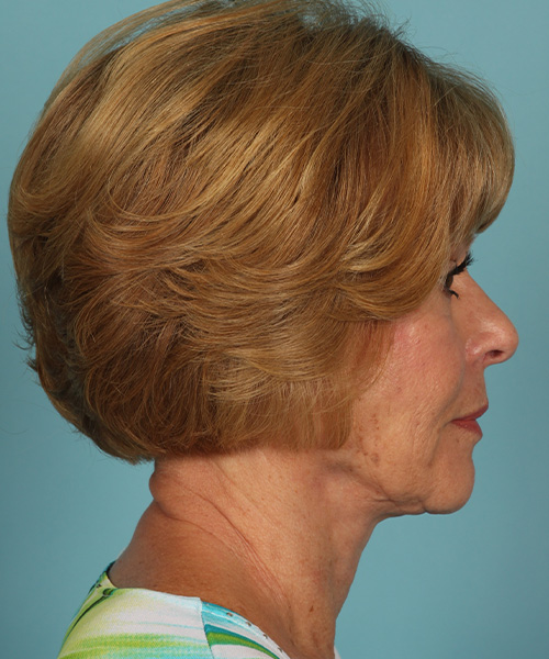 after facelift right side view female patient case 1248