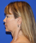 after facelift left side view female patient case 1911