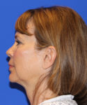 before facelift left side view female patient case 1911