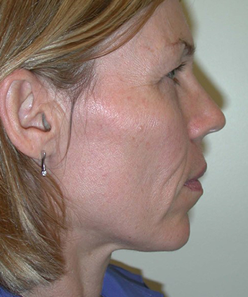 before facelift neck lift right side view female patient case 1906