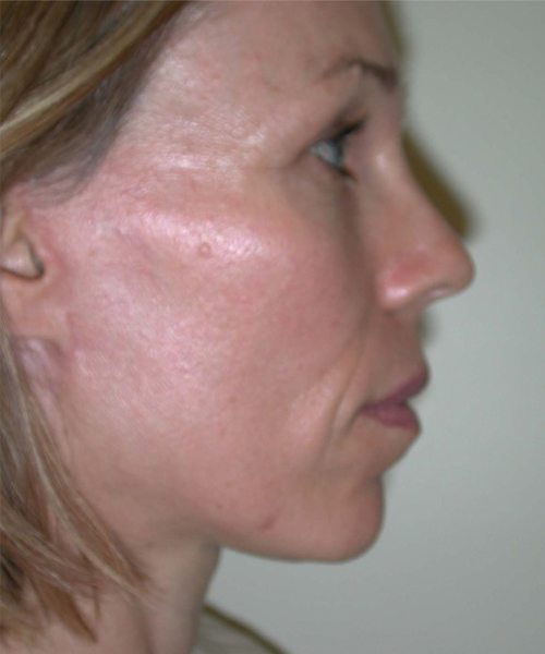 after facelift neck lift right side view female patient case 1906