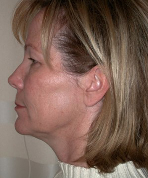 before facelift neck lift left side view female patient case 1923