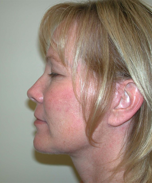 after facelift neck lift left side view female patient case 1923