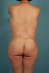 after upper and lower body lift back view female patient case 2767