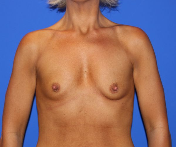 before breast augmentation front view female patient case 2735