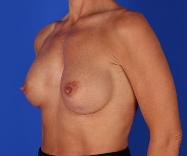 after breast augmentation left angle view female patient case 2735