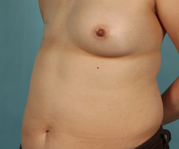 before breast reconstruction left angle view female patient case 2701