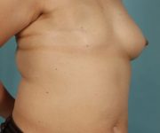 before breast reconstruction right angle view female patient case 2701