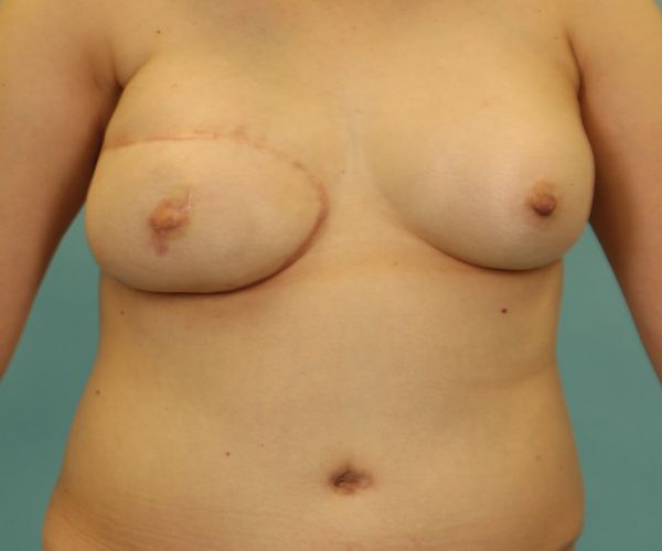 after breast reconstruction front view female patient case 2701