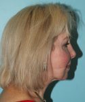 before facelift neck lift right side view female patient case 2784