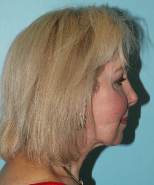 before facelift neck lift right side view female patient case 2784