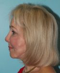 after facelift neck lift left side view female patient case 2784