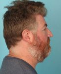 after nasal reconstruction right side view male patient case 3273