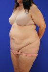 before tummy tuck left angle view female patient case 3280