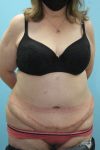 after tummy tuck front view female patient case 3280