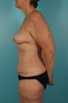 after tummy tuck left view female patient case 3291