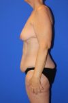 before tummy tuck left view female patient case 3291