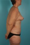 after tummy tuck right view female patient case 3291