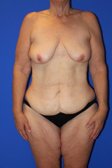 before tummy tuck front view female patient case 3291