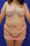 before tummy tuck front view female patient case 3280