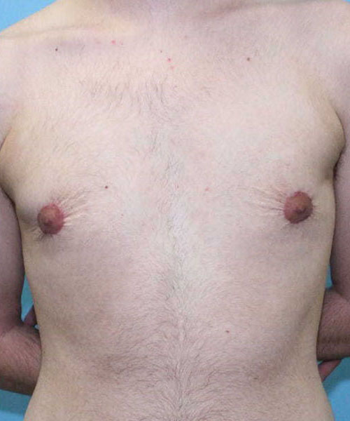 after transgender mastectomy front view transgender patient case 4388