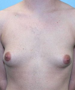 before transgender mastectomy front view transgender patient case 4388