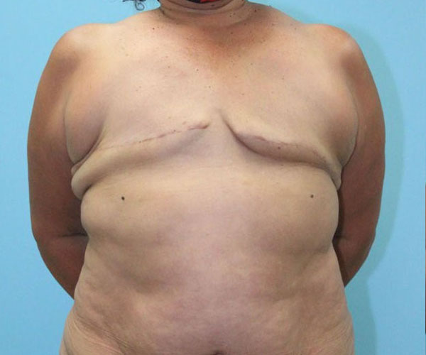 before breast reconstruction front view female patient case 4528