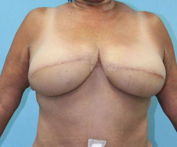 after breast reconstruction front view female patient case 4528