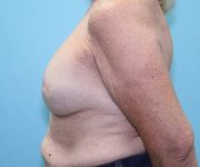 before breast reconstruction left side view female patient case 5049