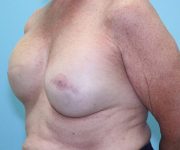 before breast reconstruction left angle view female patient case 5049