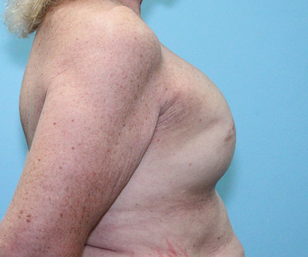 before breast reconstruction right side view female patient case 5049