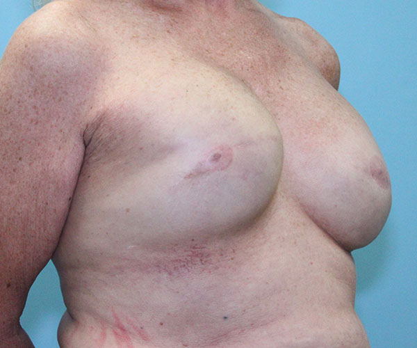 before breast reconstruction right angle view female patient case 5049