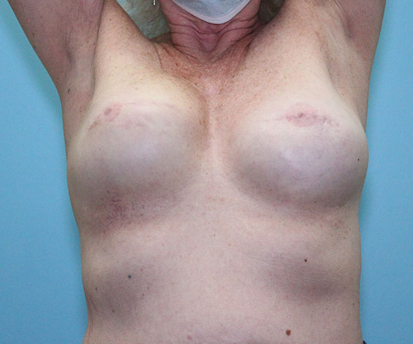 before breast reconstruction front view female patient case 5049