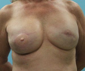 after breast reconstruction front view female patient case 5049