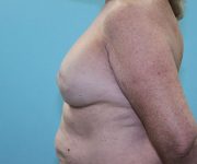 after breast reconstruction left side view female patient case 5049