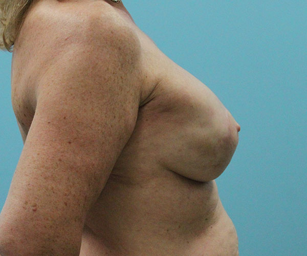 after breast reconstruction right side view female patient case 5049