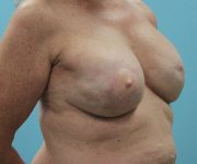 after breast reconstruction right angle view female patient case 5049