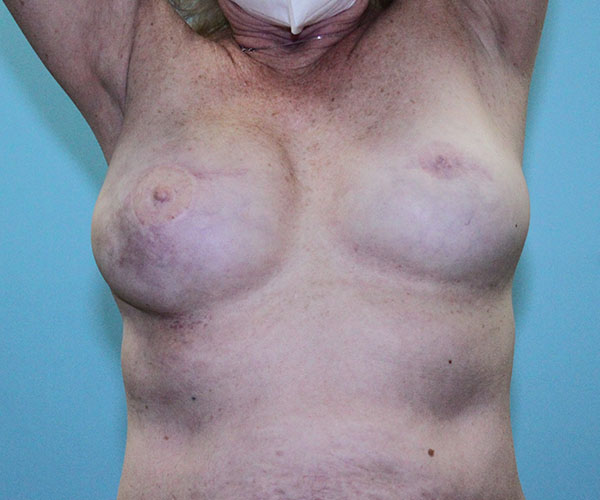 after breast reconstruction front view female patient case 5049