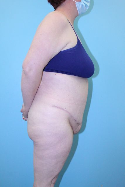 after tummy tuck right side view female patient case 5014