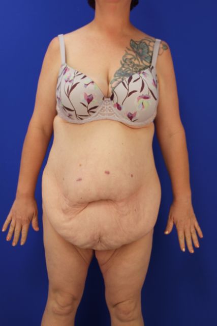 before tummy tuck front view female patient case 5014