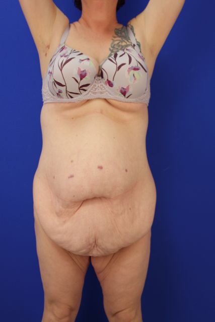 before tummy tuck front arms up view female patient case 5014