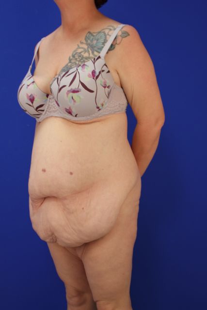 before tummy tuck left angle view female patient case 5014