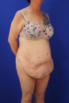 before tummy tuck right angle view female patient case 5014