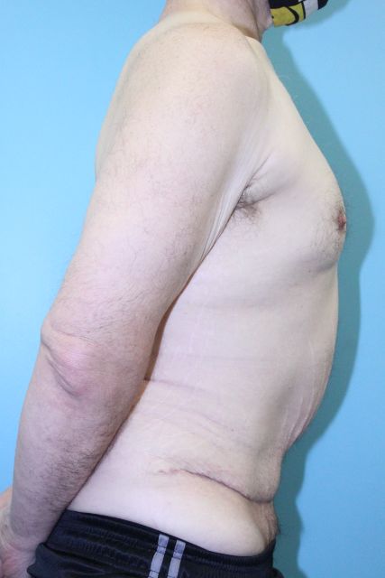 after tummy tuck right side view male patient case 5032