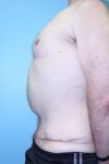 after tummy tuck left side view male patient case 5032