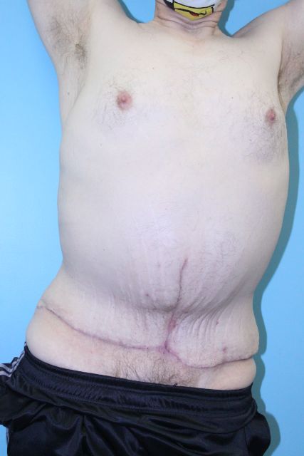 after tummy tuck front arms up view male patient case 5032