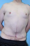 after tummy tuck front view male patient case 5032