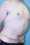 after tummy tuck right angle view male patient case 5032