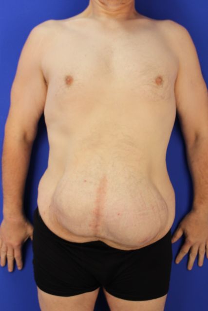 before tummy tuck front view male patient case 5032